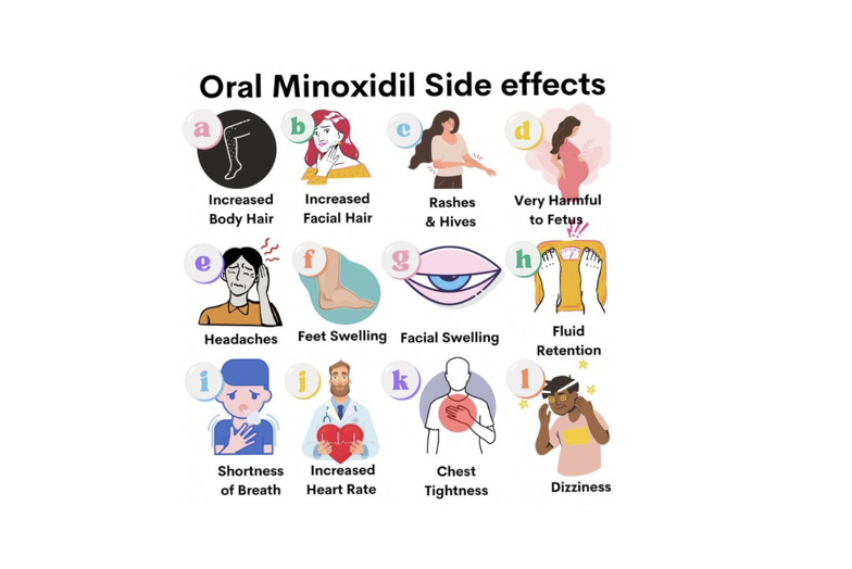 Oral vs. Topical Minoxidil: overview