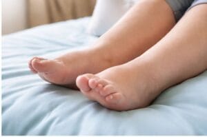 pregnancy leg swelling